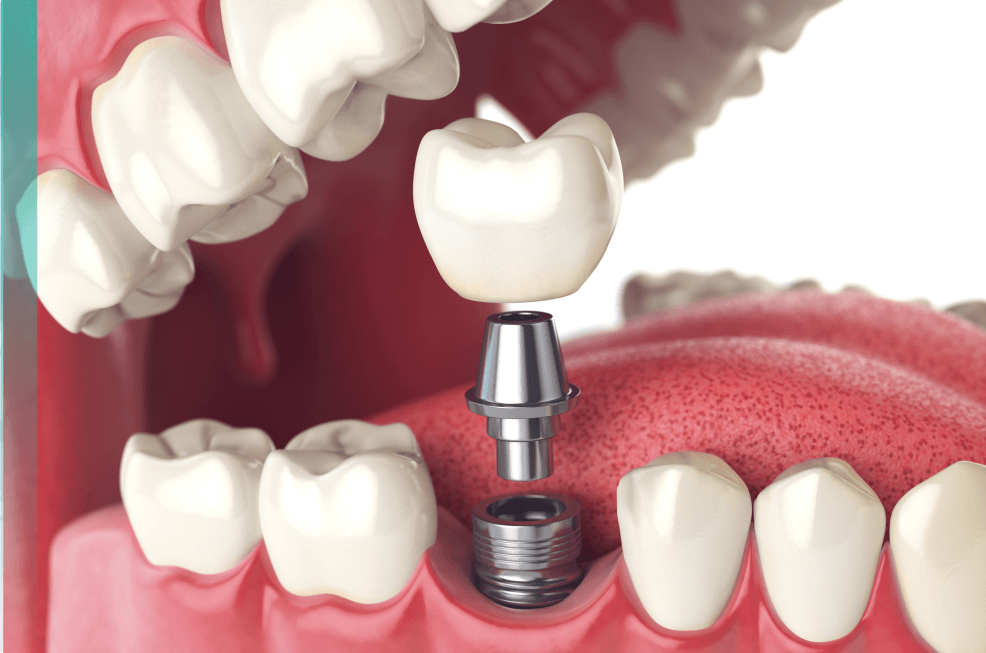 dental work in istanbul dentspa